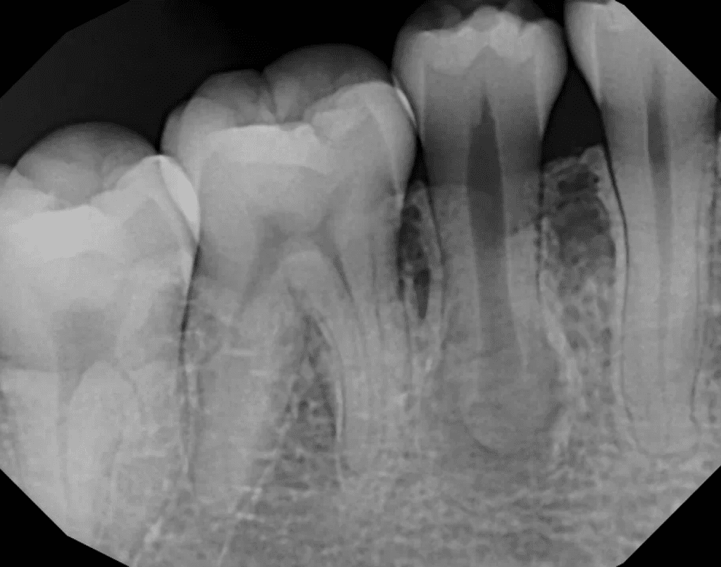 Tooth #29 dens evaginatus pre-op by Cincinnati endodontist Dr. Sullivan of Mason Endodontics and Microsurgery