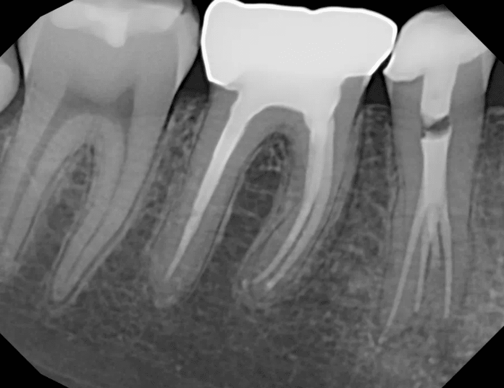 Lower premolar with furcal canal post-op by Cincinnati endodontist Dr. Sullivan of Mason Endodontics and Microsurgery