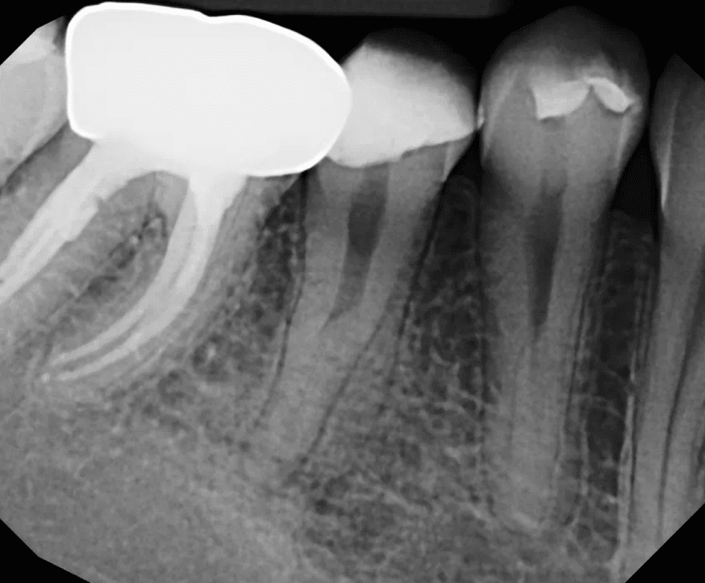 Lower premolar with furcal canal pre-op by Cincinnati endodontist Dr. Sullivan of Mason Endodontics and Microsurgery