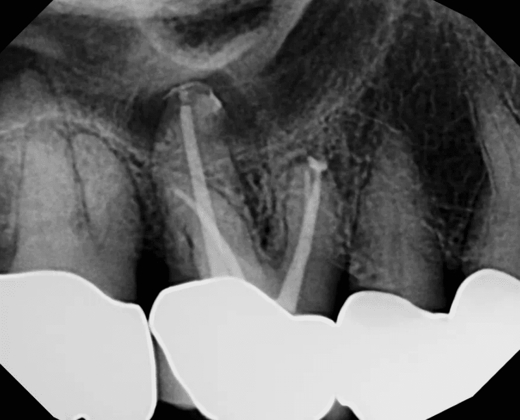 Root canal on tooth #3 completed by Dr. Matthew Sullivan