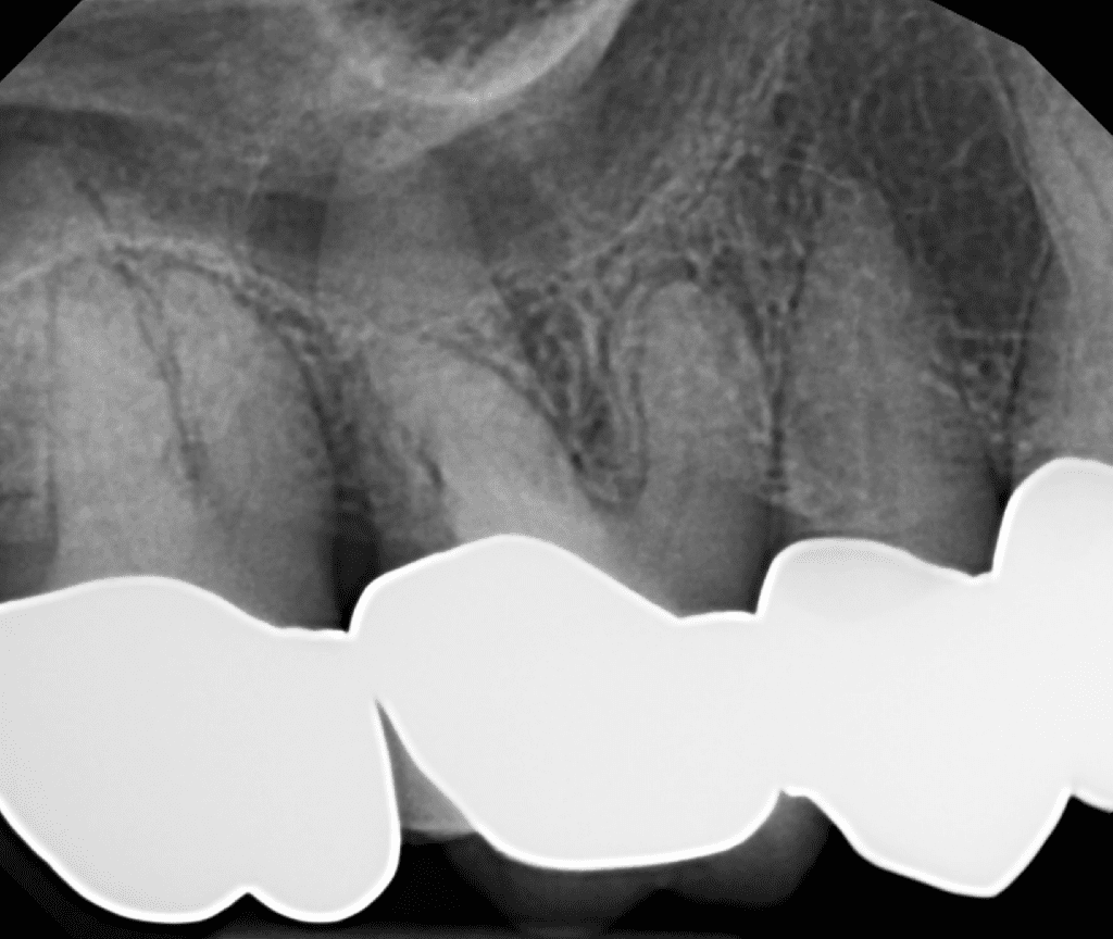 #3 root canal pre-op radiograph