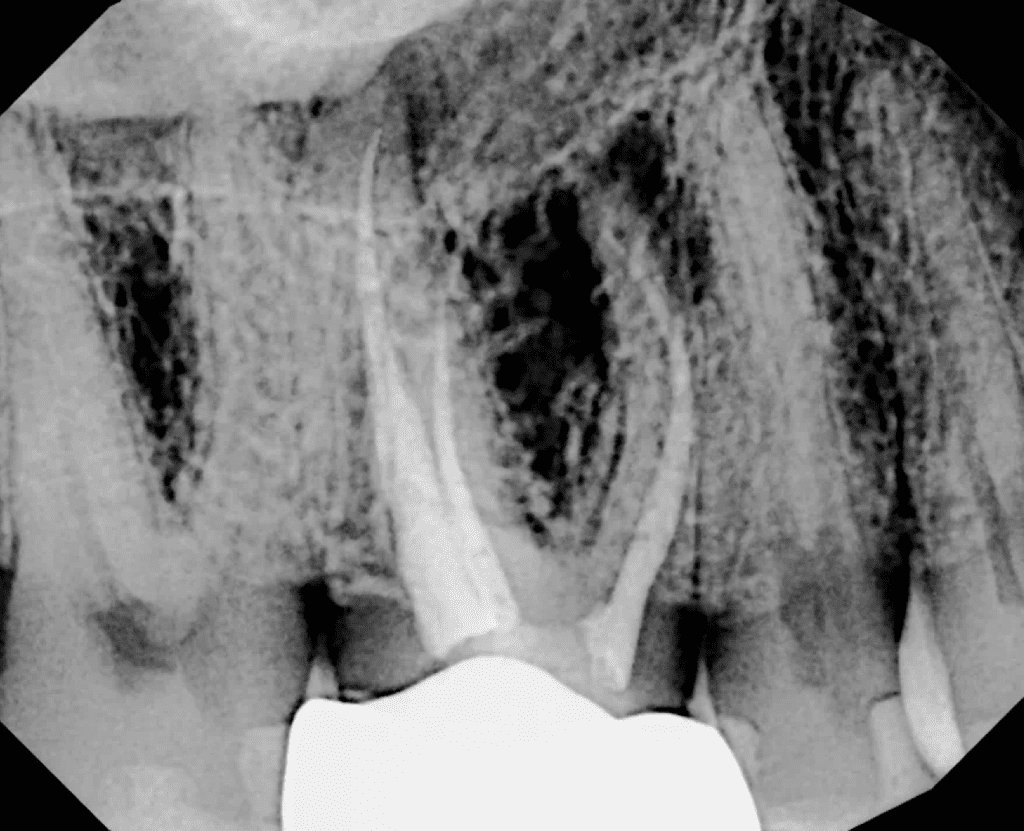 Tooth #3 pre-op radiograph root canal retreatment