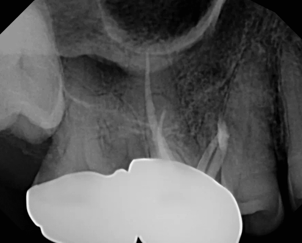 Apical microsurgery on tooth #3 completed by Dr. Matthew Sullivan