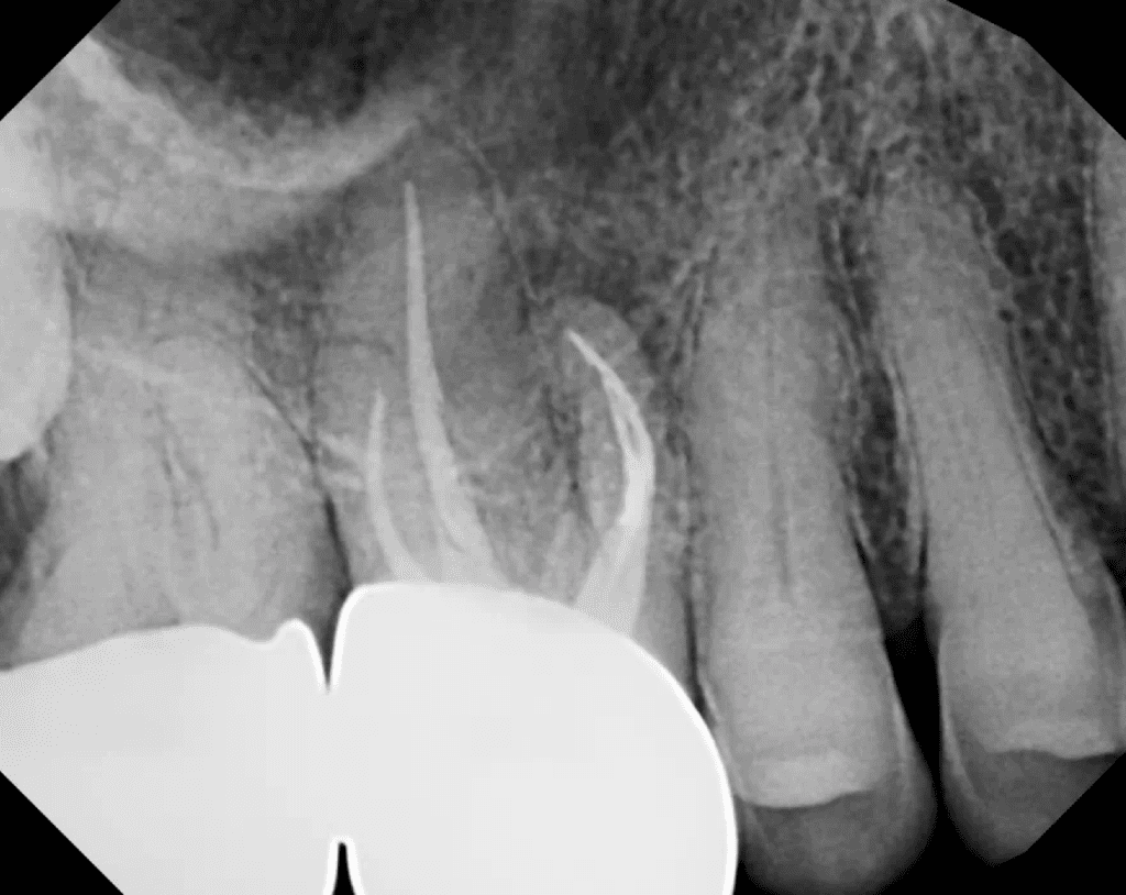 Upper molar pre-op x-ray prior to endodontic apical surgery.