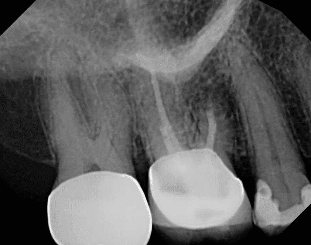 Endodontic surgery completed by Cincinnati endodontist Dr. Matthew Sullivan 