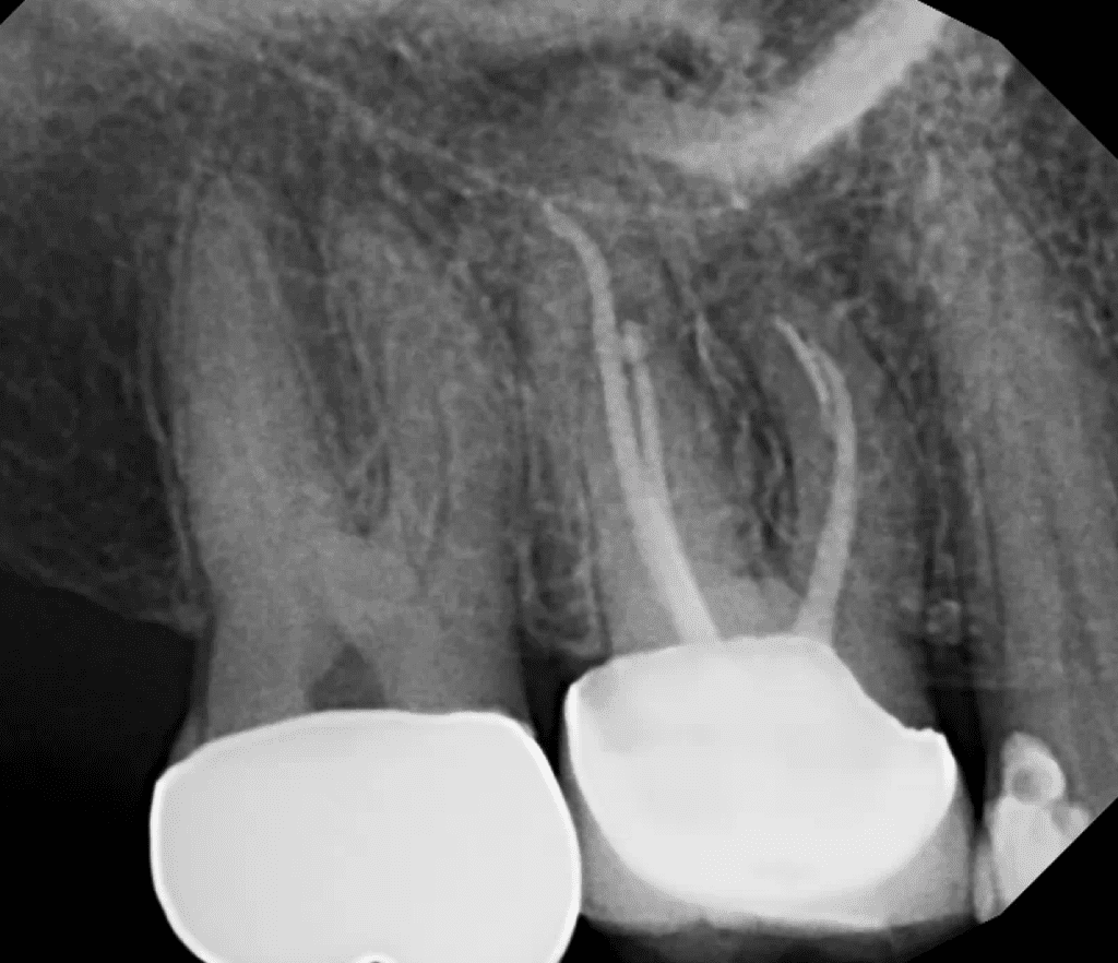 Tooth #3 pre-op radiograph prior to endodontic apical surgery by Dr. Sullivan of Mason Endodontics and Microsurgery.