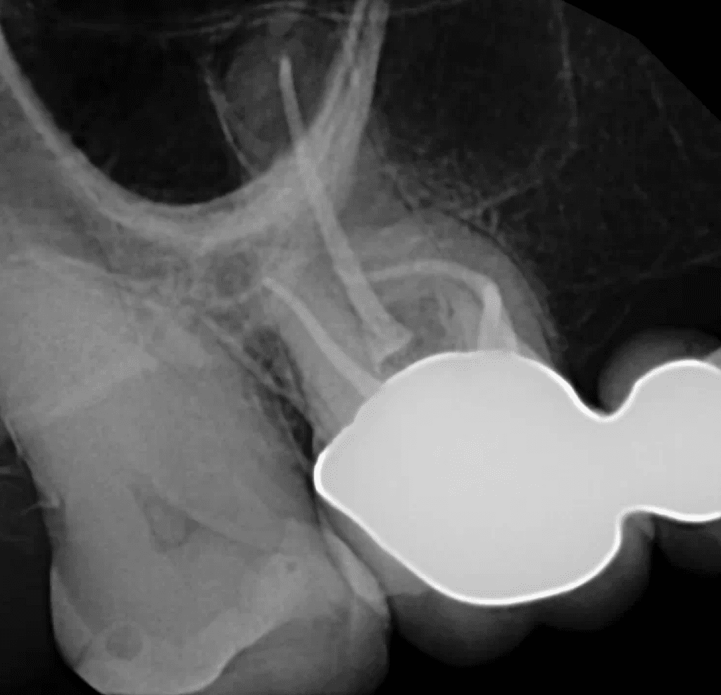 Root canal on tooth #3 completed by Dr. Matthew Sullivan of Mason Endodontics and Microsurgery.