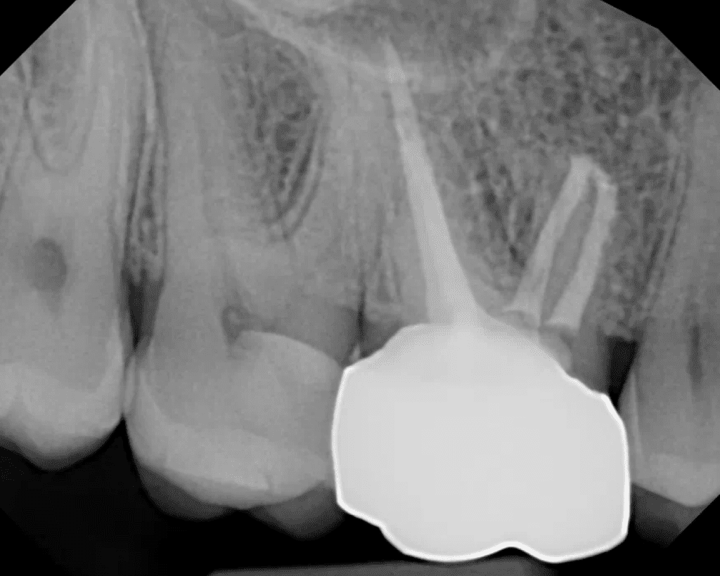 Apical surgery completed by Cincinnati endodontist Dr. Matthew Sullivan 