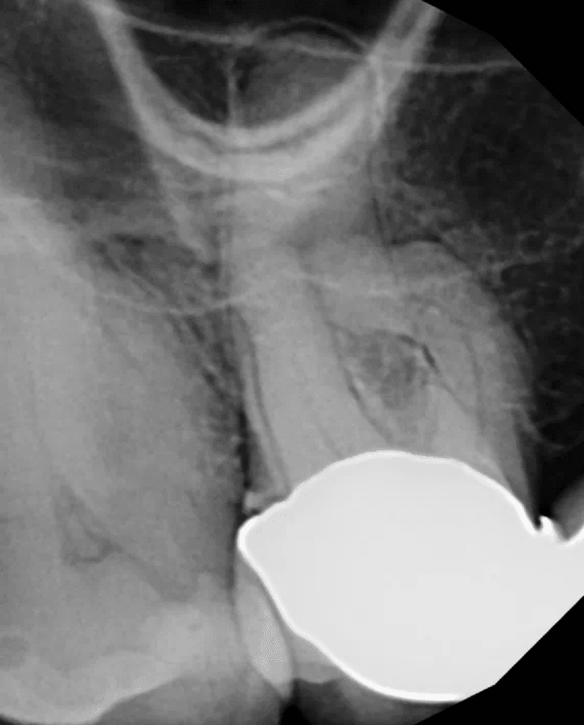 Upper molar pre-op root canal x-ray.  Mason Endodontics and Microsurgery.