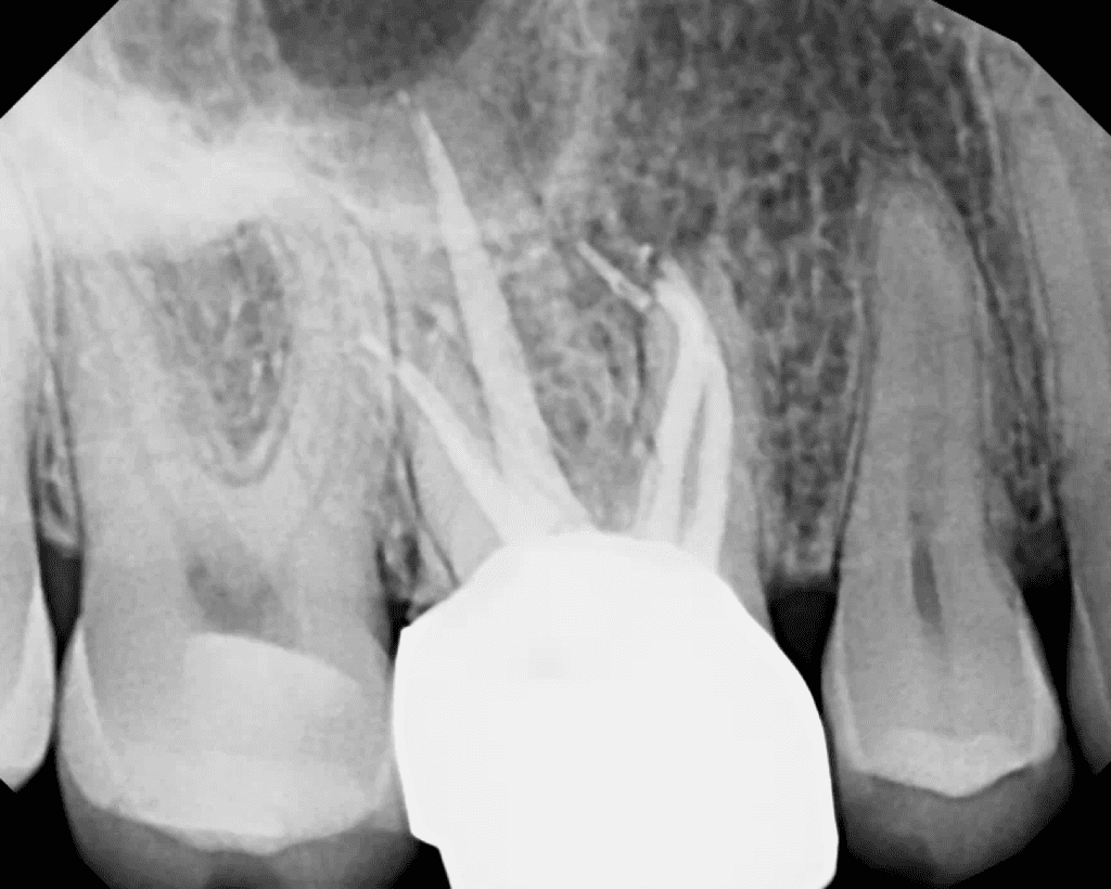 Tooth #3 MB Root Apical Surgery Pre-Op