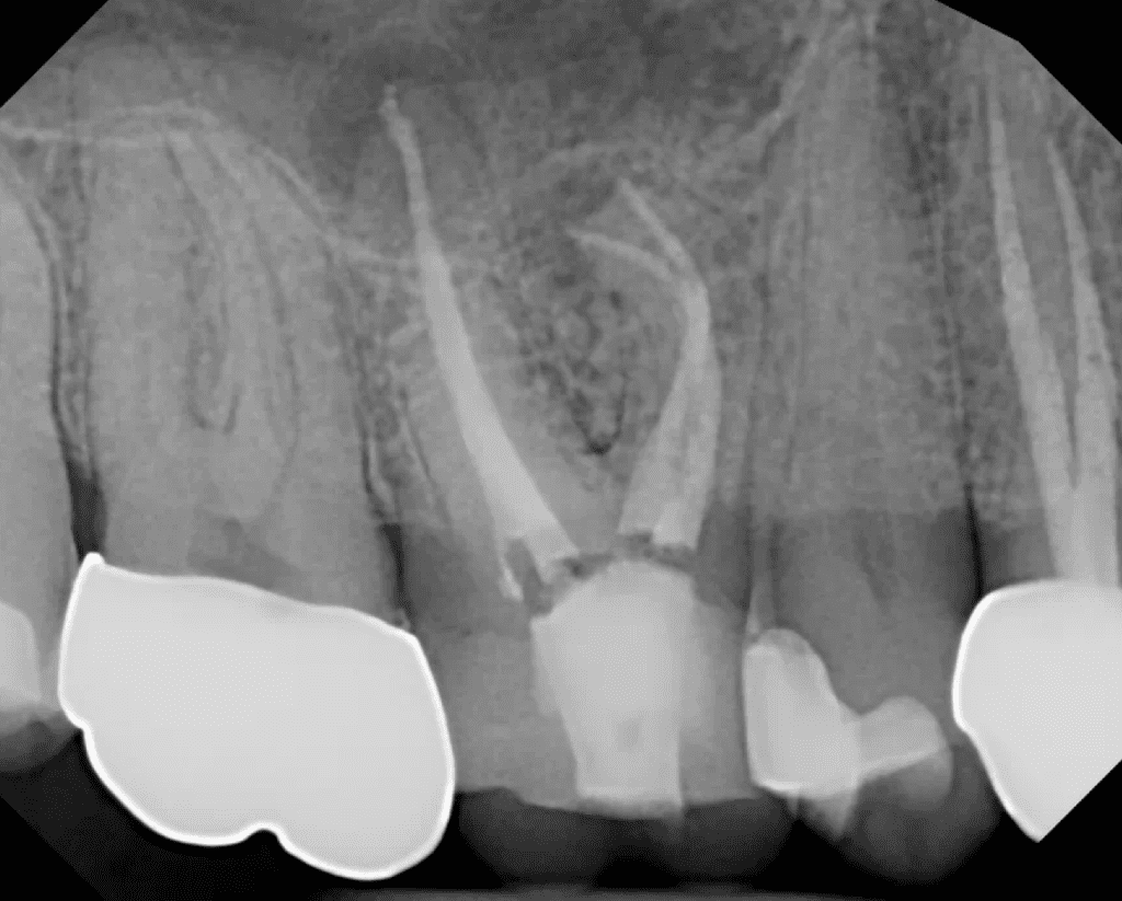 Upper molar retreatment deep canal split post-op by Cincinnati endodontist Dr. Sullivan of Mason Endodontics and Microsurgery.