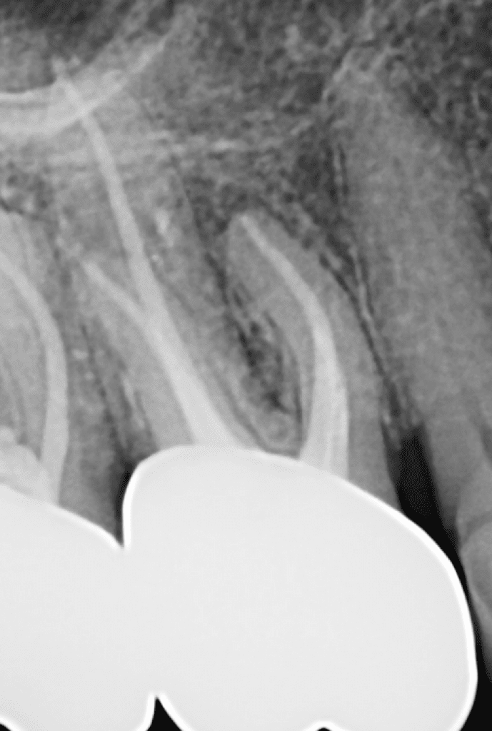 #3 root canal retreatment completed by Dr. Matthew Sullivan of Mason Endodontics and Microsurgery