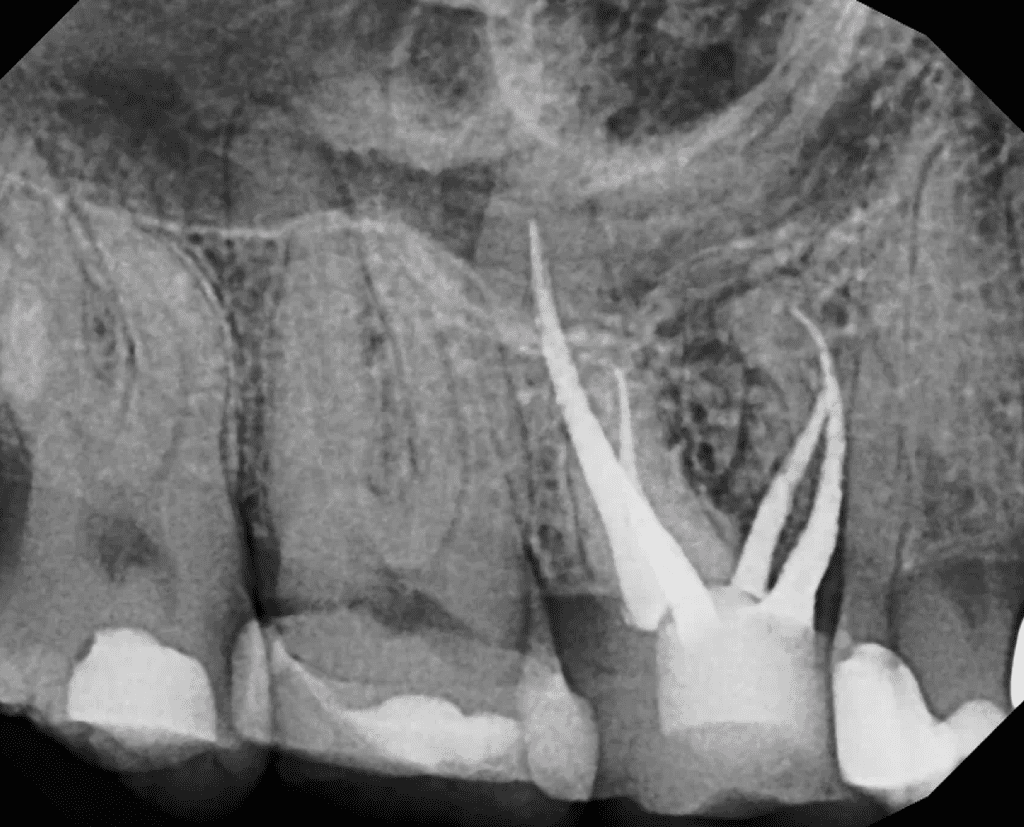 Upper molar retreatment deep canal split pre-op by Cincinnati endodontist Dr. Sullivan of Mason Endodontics and Microsurgery.