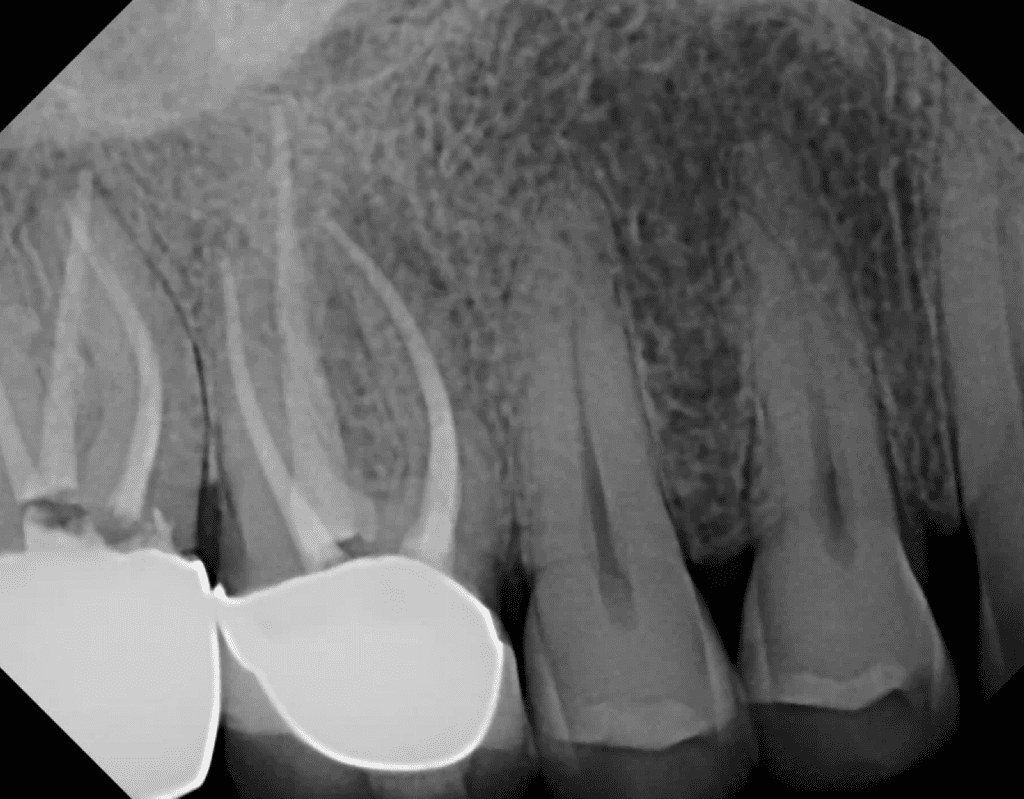 Upper molar root canal retreatment completed by Cincinnati endodontist Dr. Matthew Sullivan of Mason Endodontics and Microsurgery