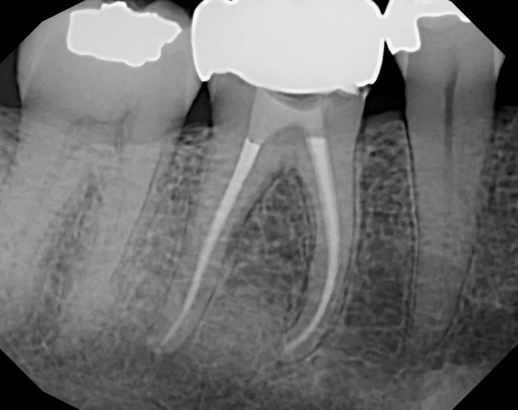 Lower root canal molar post-op by Cincinnati endodontist Dr. Matthew Sullivan of Mason Endodontics and Microsurgery