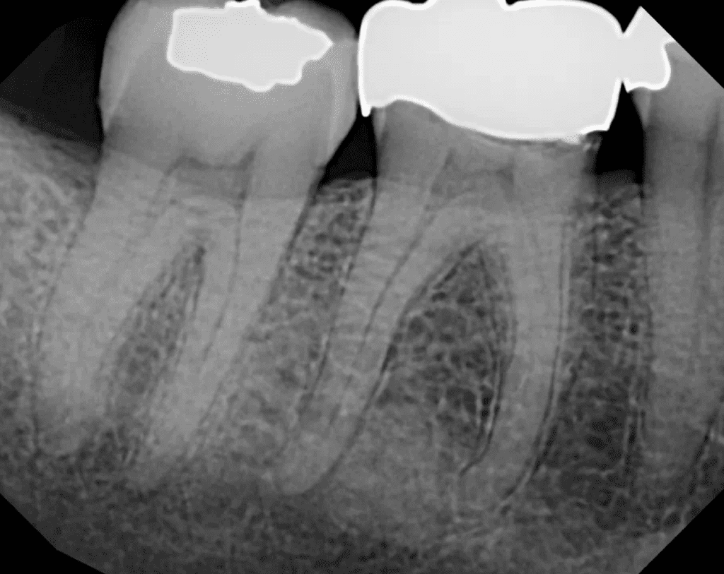 Lower molar pre-op by Cincinnati endodontist Dr. Sullivan of Mason Endodontics and Microsurgery