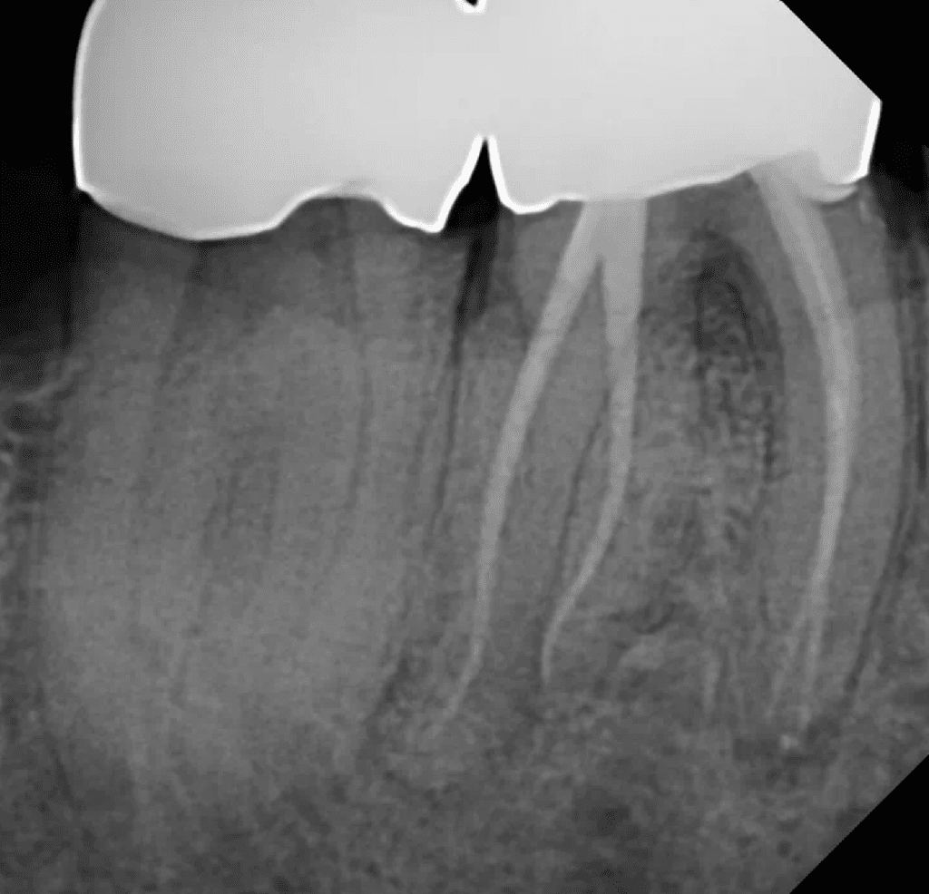 Lower molar with curvy radix root canal post-op by Cincinnati endodontist Dr. Sullivan of Mason Endodontics and Microsurgery