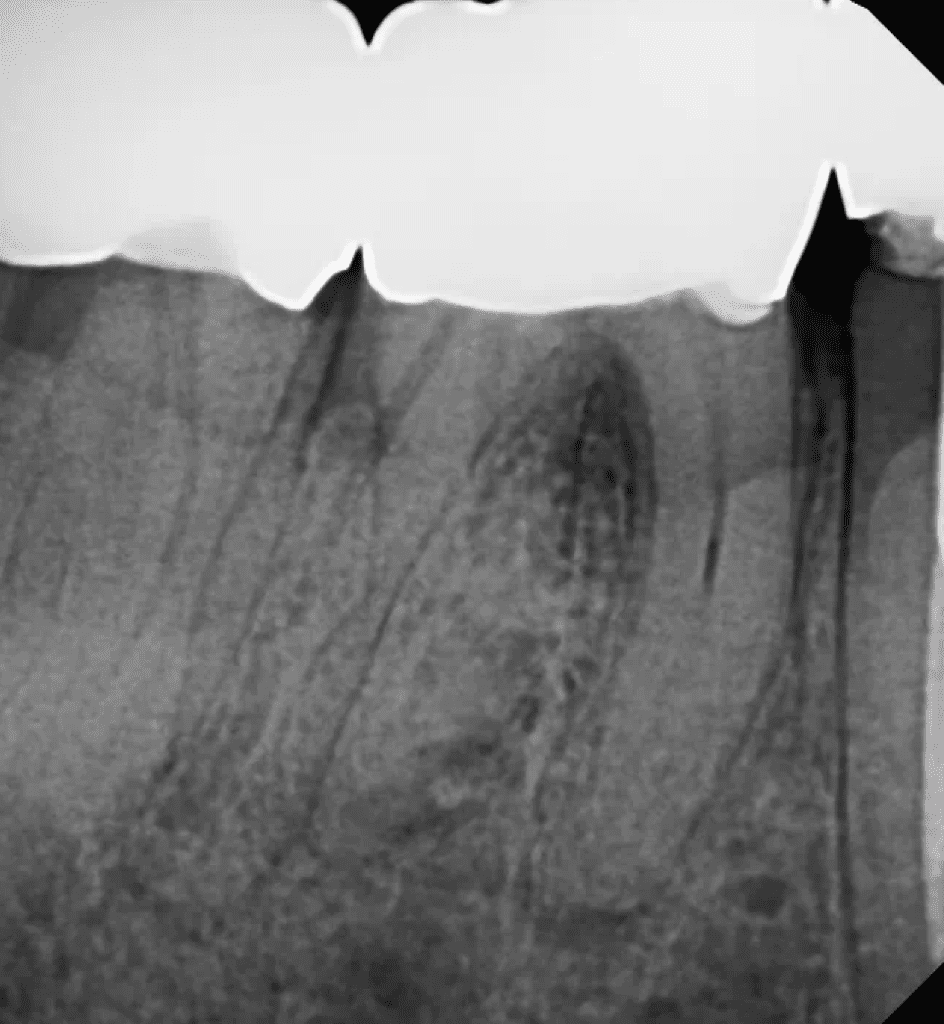 Lower molar with radix root canal pre-op by Cincinnati endodontist Dr. Sullivan of Mason Endodontics and Microsurgery