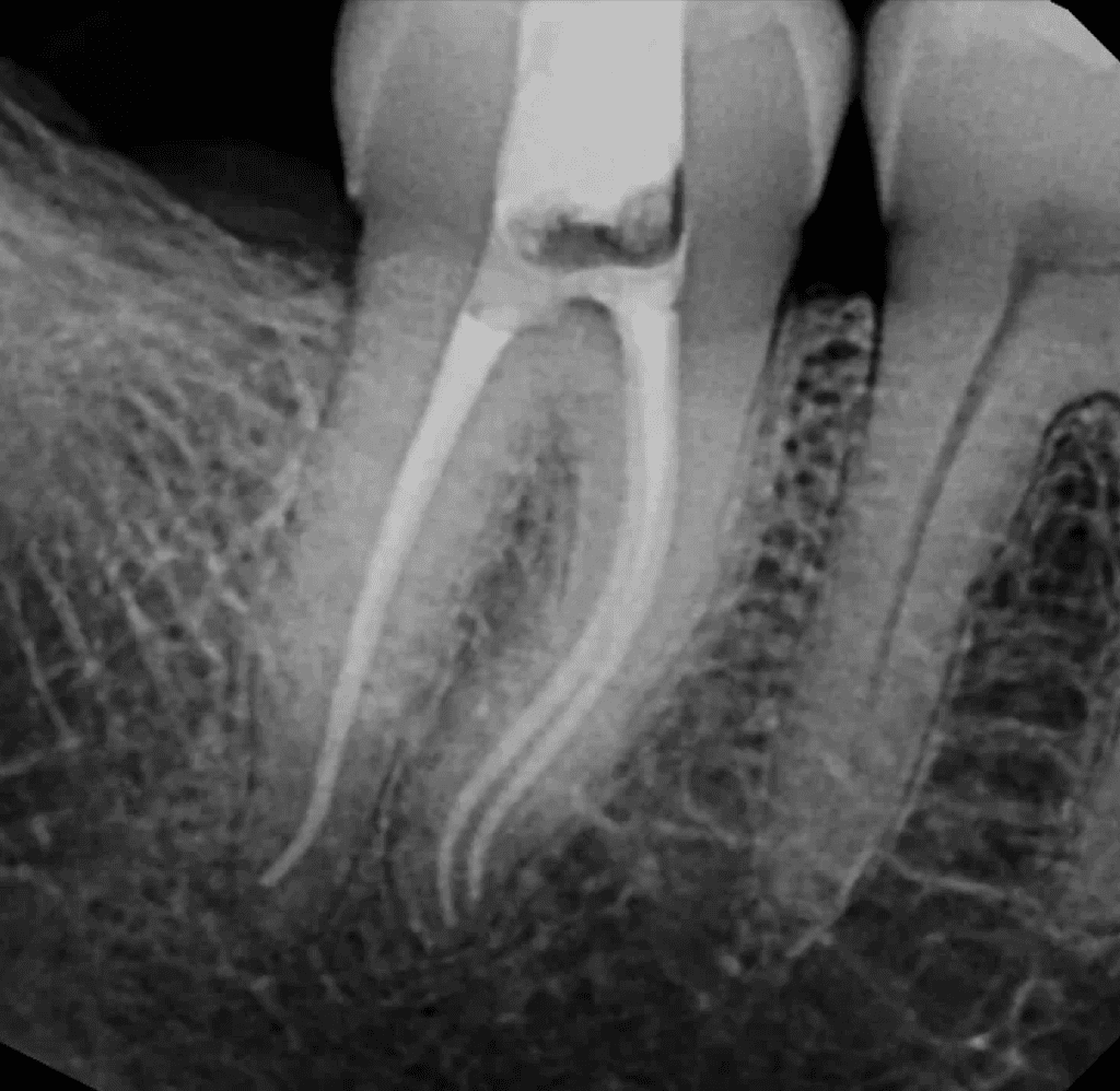 Lower molar root canal post-op by Cincinnati endodontist Dr. Sullivan of Mason Endodontics and Microsurgery.