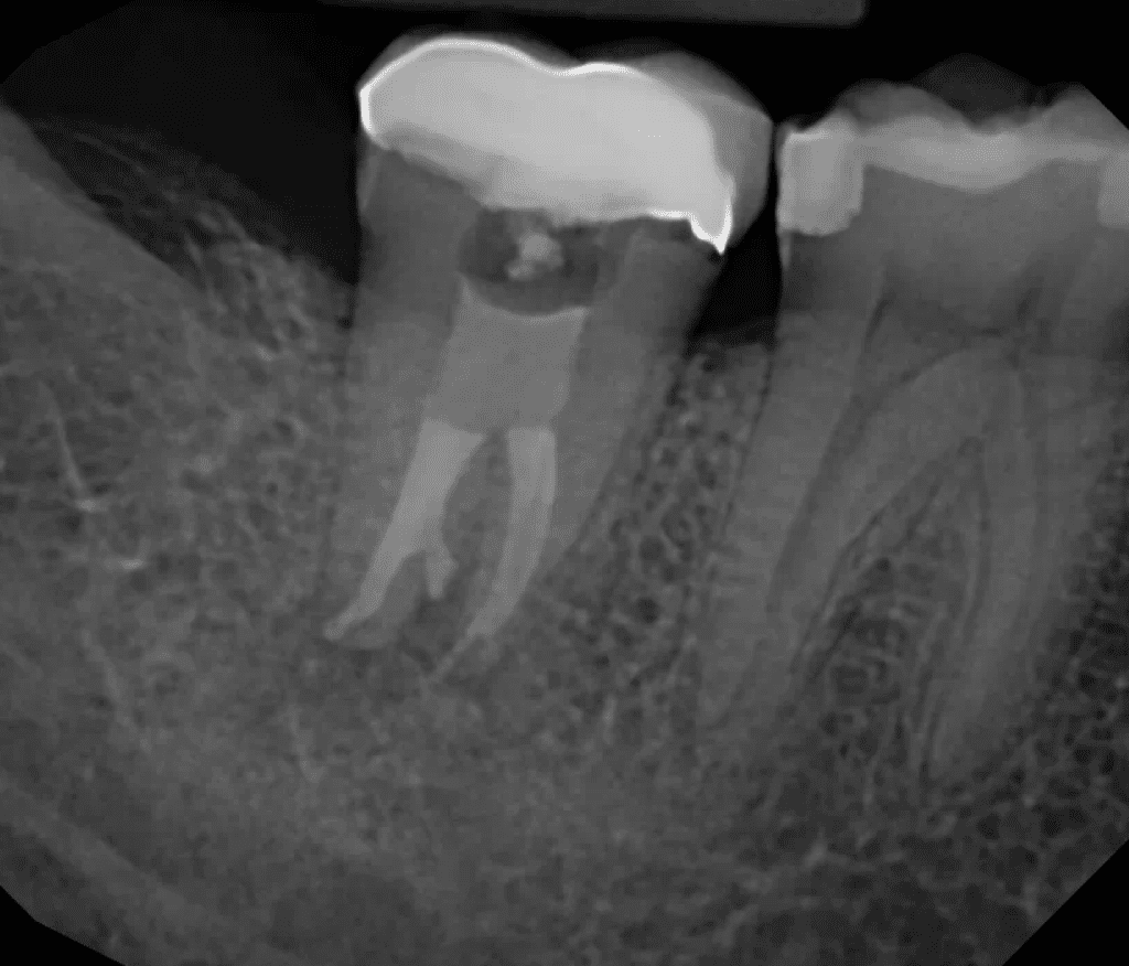 Root canal with resorption repair post-op completed by Cincinnati endodontist Dr. Sullivan of Mason Endodontics and Microsurgery.
