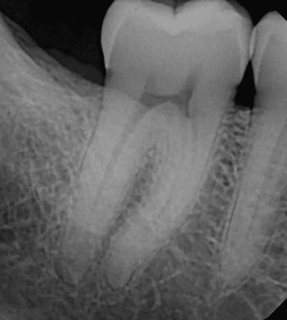 Lower molar root canal pre-op by Cincinnati endodontist Dr. Sullivan of Mason Endodontics and Microsurgery.