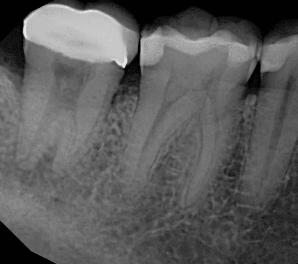 Lower molar with resorption root canal pre-op by Cincinnati endodontist Dr. Sullivan of Mason Endodontics and Microsurgery.