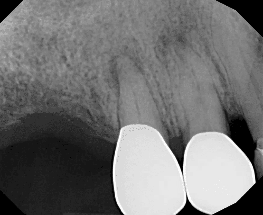 Teeth #4 and #5 pre-op radiograph - Cincinnati endodontist Dr. Sullivan of Mason Endodontics and Microsurgery