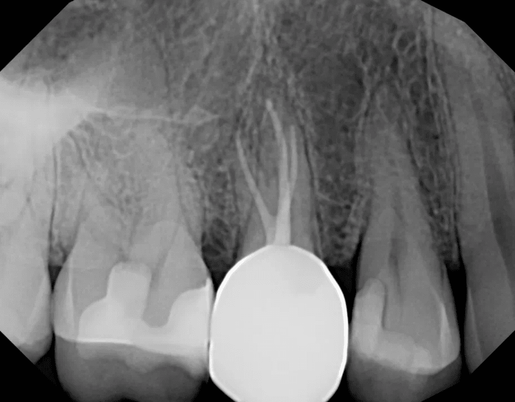 Root canal on tooth #4 with complex canal anatomy completed by Dr. Matthew Sullivan of Mason Endodontics and Microsurgery
