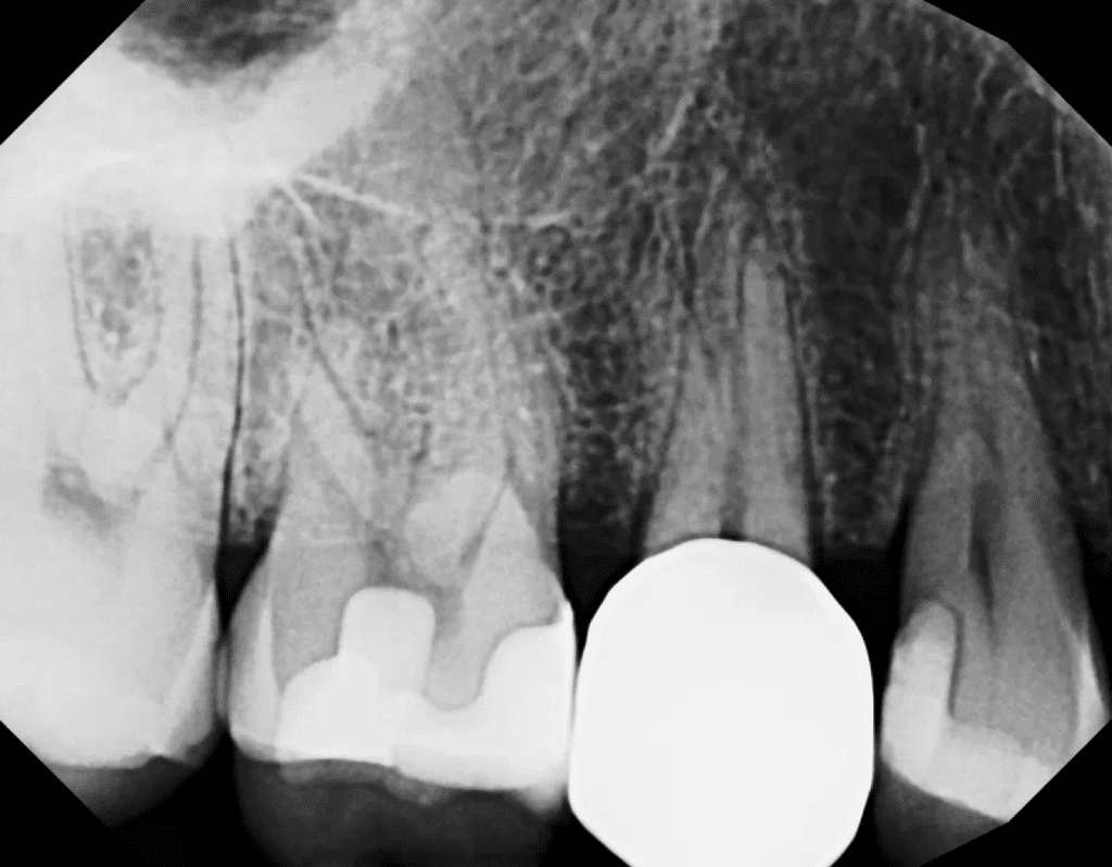 Tooth #4 Endodontic Therapy Pre-Op