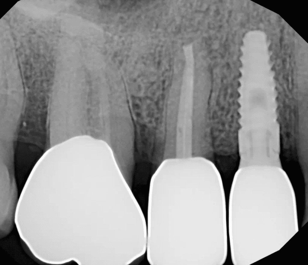 Endodontic surgery completed by Dr. Sullivan of Mason Endodontics and Microsurgery in Cincinnati
