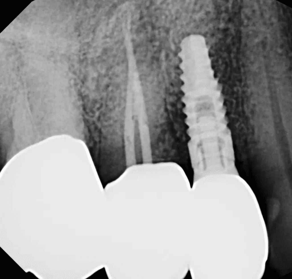 Tooth #4 apical surgery pre-op - Mason Endodontics and Microsurgery