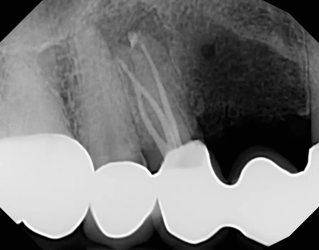 Root canal on tooth #5 completed by Dr. Matthew Sullivan at Mason Endodontics and Microsurgery