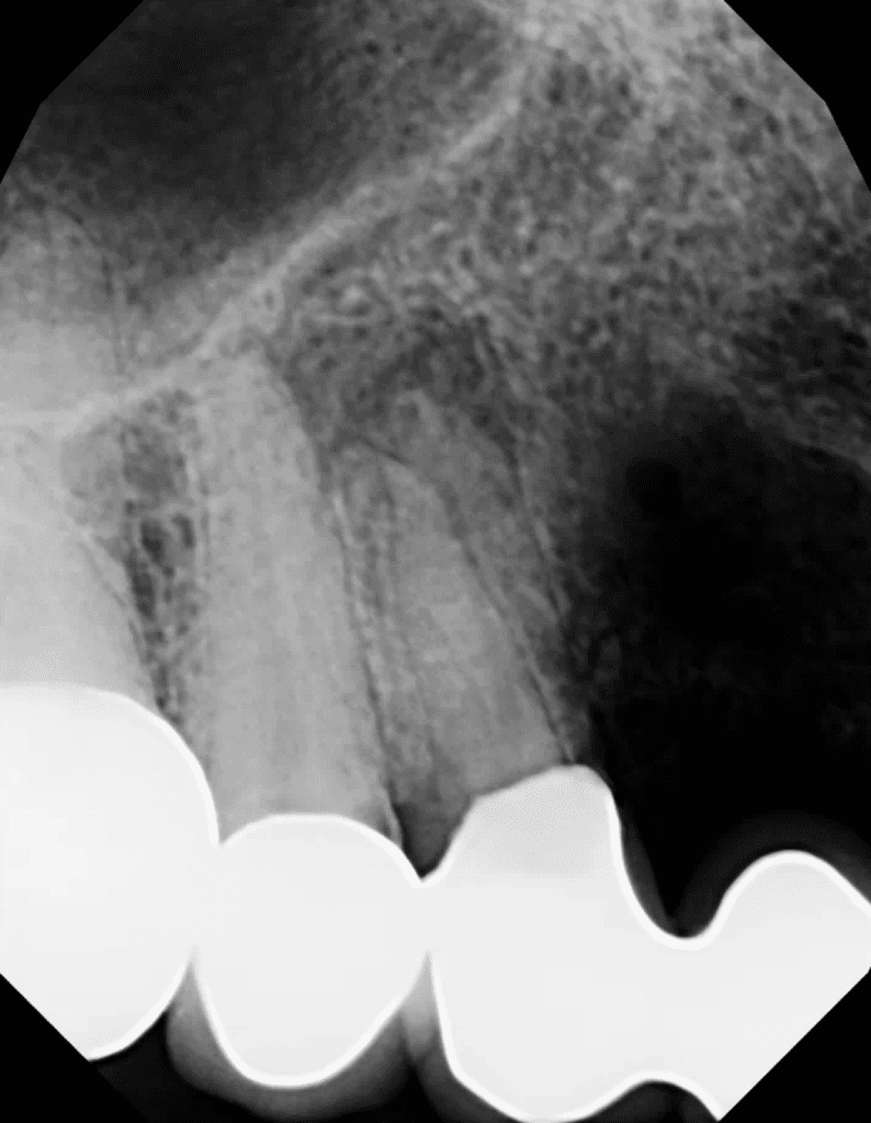 Pre-op x-ray prior to root canal on tooth #5 by Cincinnati endodontist Dr. Matthew Sullivan.