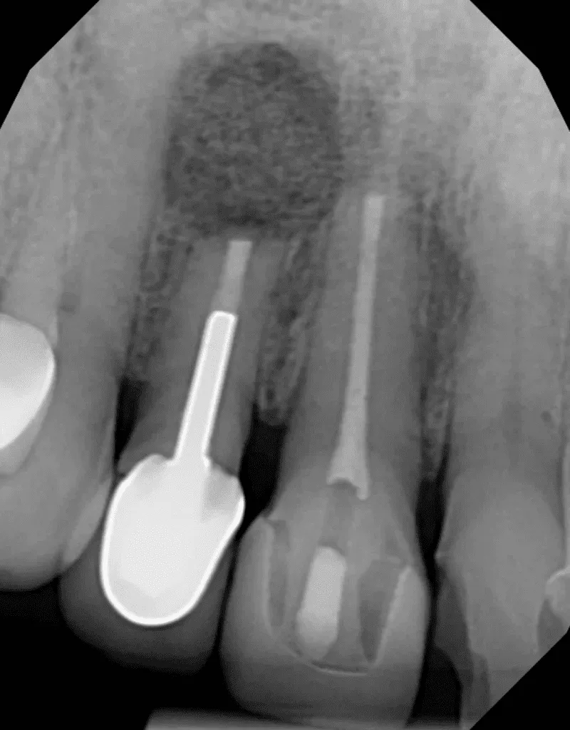 Apical surgery on teeth #7 and #8 completed by Cincinnati endodontist Dr. Matthew Sullivan