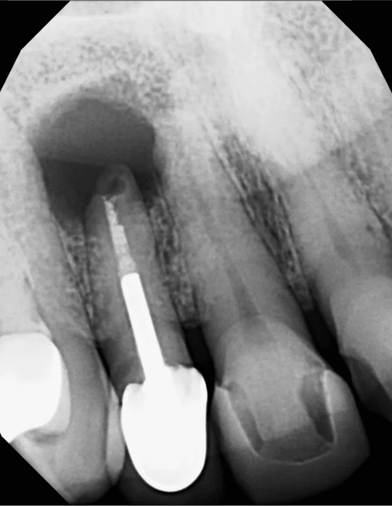 Maxillary incisors pre-op radiograph prior to root canals and endodontic surgery by Dr. Matthew Sullivan of Mason Endodontics and Microsurgery.