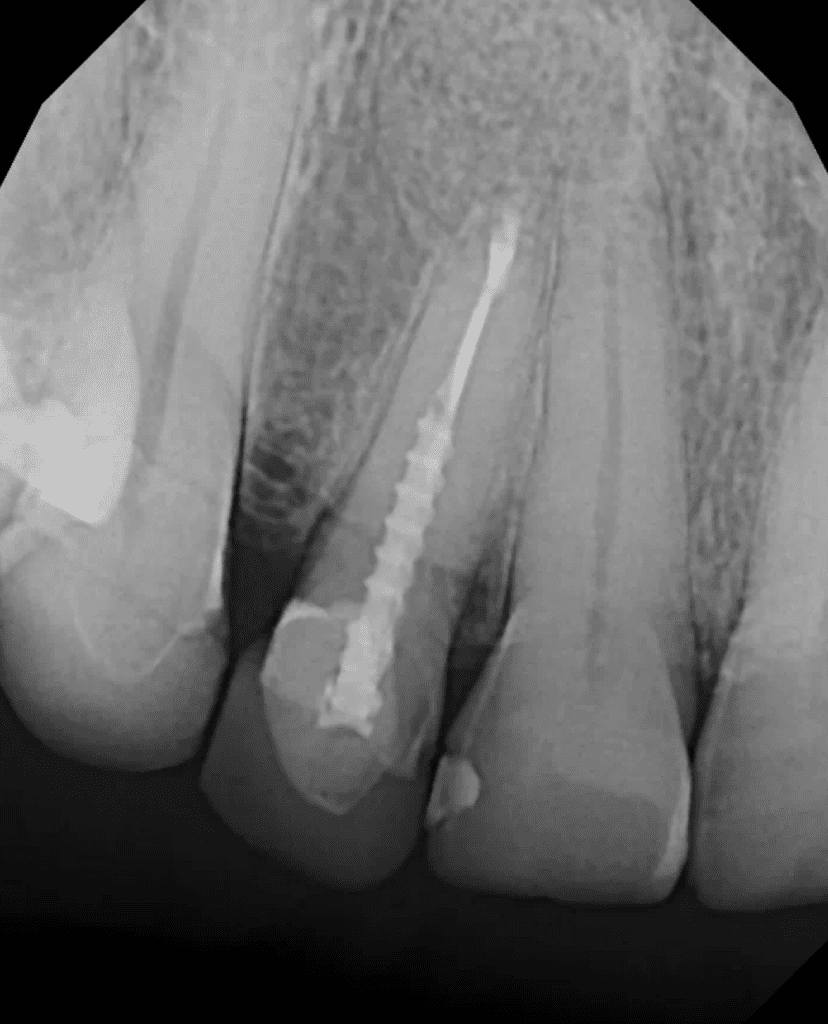 Tooth #7 post-op radiograph after endodontic surgery by Dr. Matthew Sullivan of Mason Endodontics and Microsurgery.