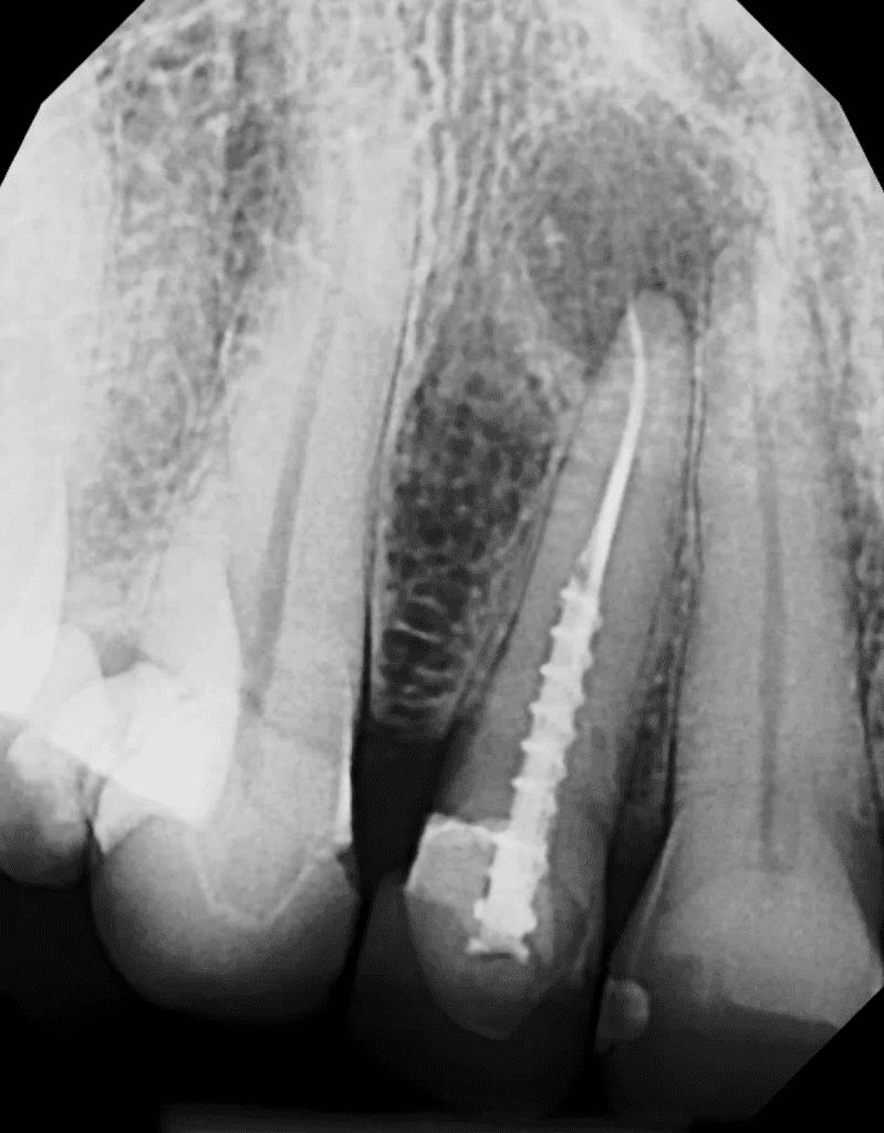 Tooth #7 (upper lateral incisor) pre-op radiograph prior to endodontic surgery by Dr. Matthew Sullivan of Mason Endodontics and Microsurgery.