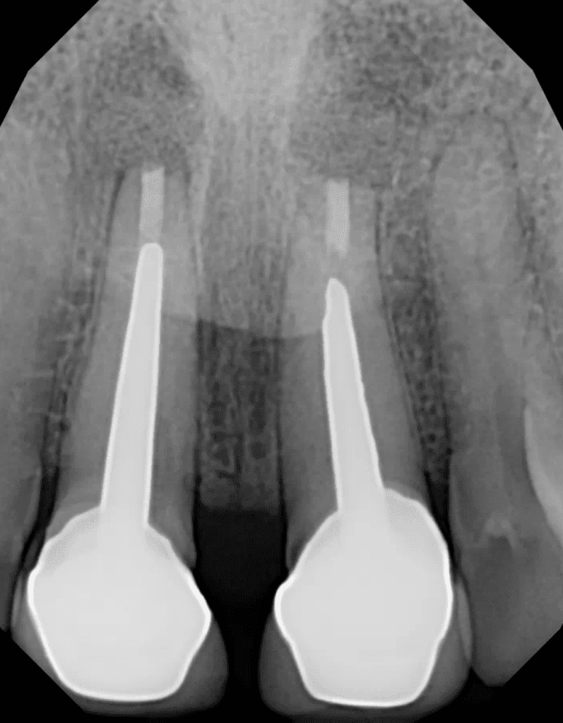 Apical surgery to save a patient's two front teeth completed by Cincinnati endodontist Dr. Matthew Sullivan of Mason Endodontics and Microsurgery