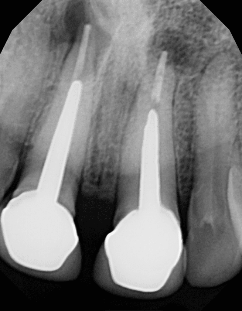 Maxillary incisors pre-op radiograph prior to endodontic surgery by Dr. Matthew Sullivan of Mason Endodontics and Microsurgery.