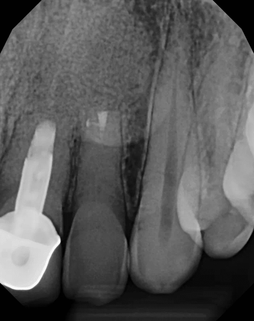 6-month recall showing excellent healing after apical surgery by Dr. Sullivan of Mason Endodontics and Microsurgery