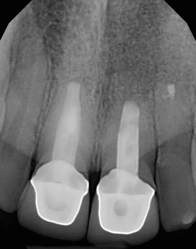 Upper teeth endodontic apical surgery showing excellent bone fill and healing.
