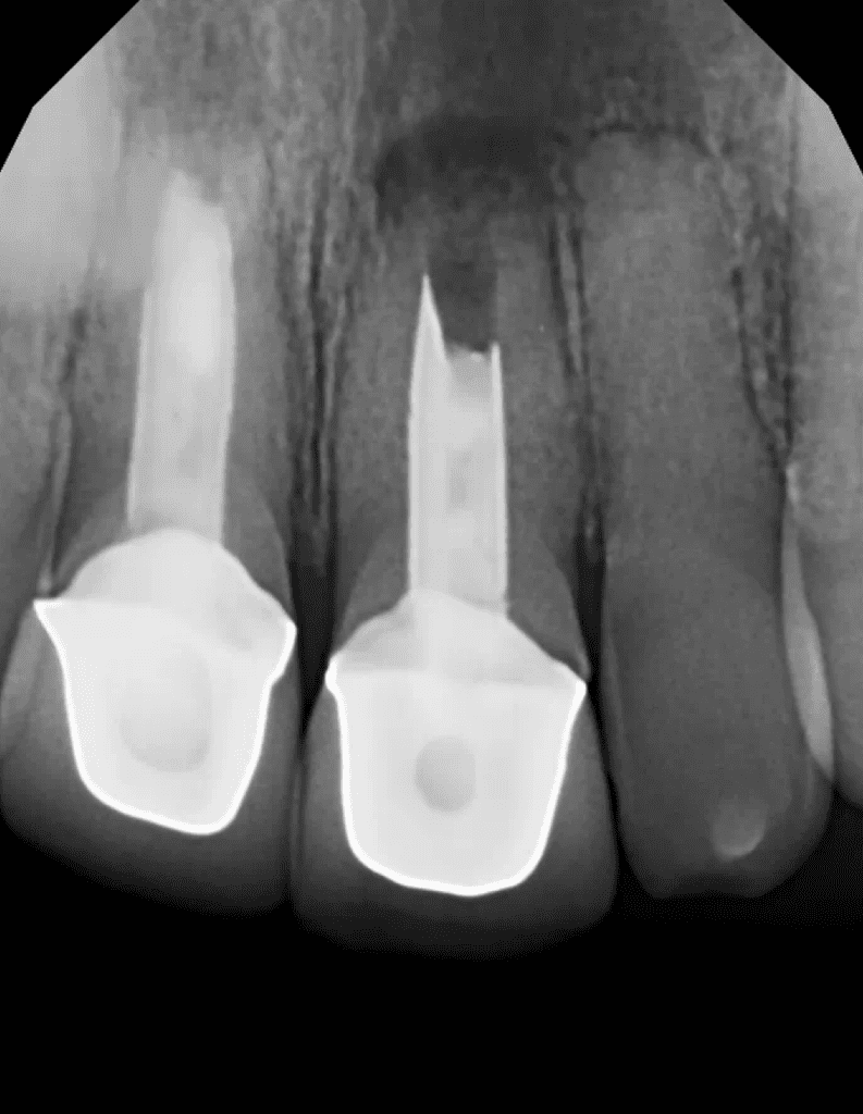 Maxillary incisors pre-op radiograph prior to endodontic surgery by Dr. Matthew Sullivan of Mason Endodontics and Microsurgery.