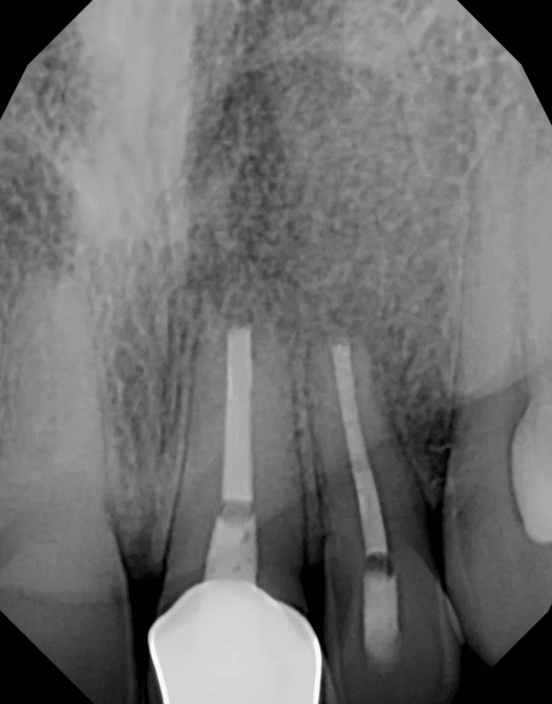 Surgery post-op by Cincinnati endodontist Dr. Sullivan