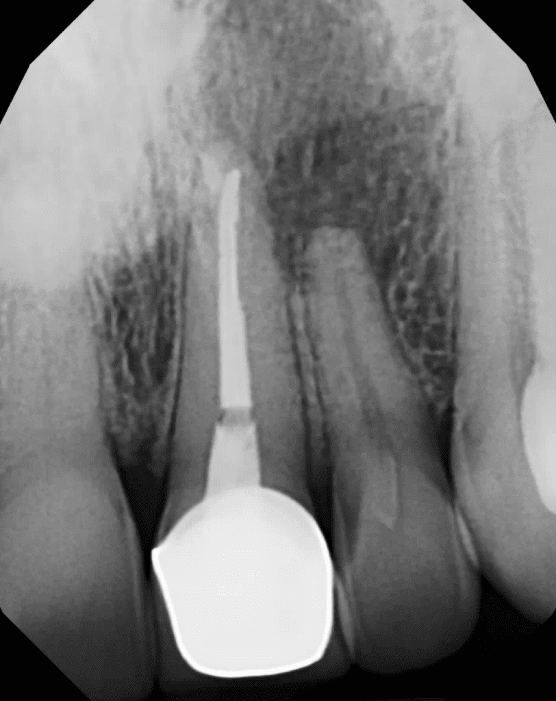 Maxillary incisors pre-op radiograph prior to endodontic therapy (root canal treatment) and endodontic surgery by Dr. Matthew Sullivan of Mason Endodontics and Microsurgery.