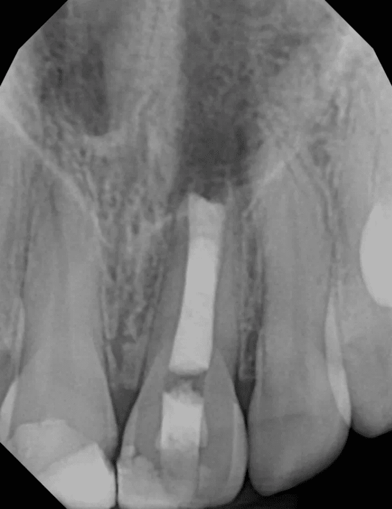 MTA plug obturation by Cincinnati endodontist Dr. Matthew Sullivan of Mason Endodontics and Microsurgery