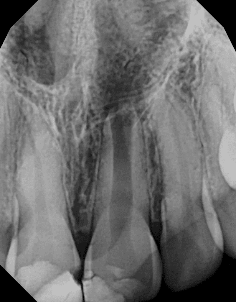 Maxillary incisor pre-op radiograph prior to root canal with MTA plug by Dr. Matthew Sullivan of Mason Endodontics and Microsurgery.