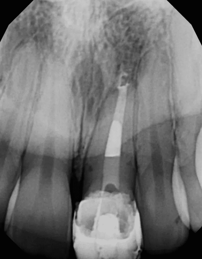 MTA Plug and internal bleaching completed by Cincinnati endodontist Dr. Matthew Sullivan of Mason Endodontics and Microsurgery