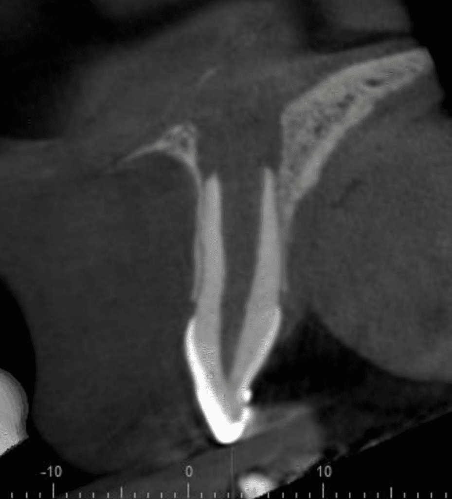 CBCT image of open apex tooth #9 - Mason Endodontics and Microsurgery