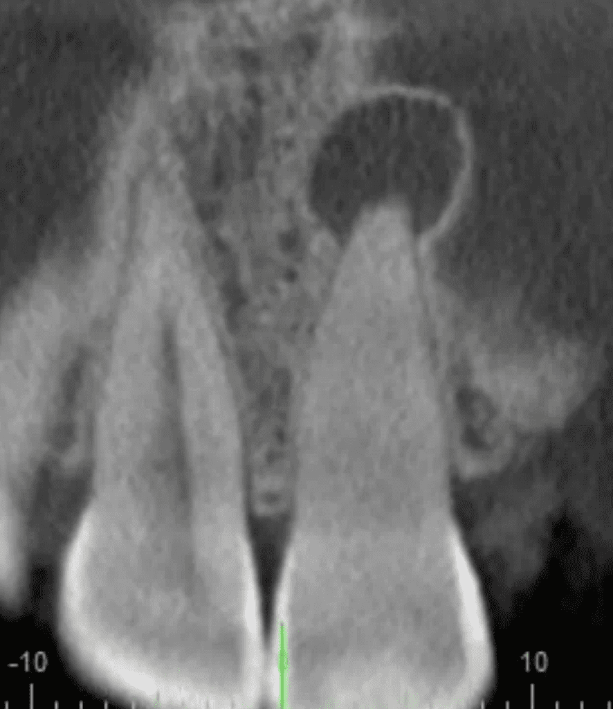 Calcified root canal on CBCT treated by Dr. Sullivan of Mason Endodontics and Microsurgery