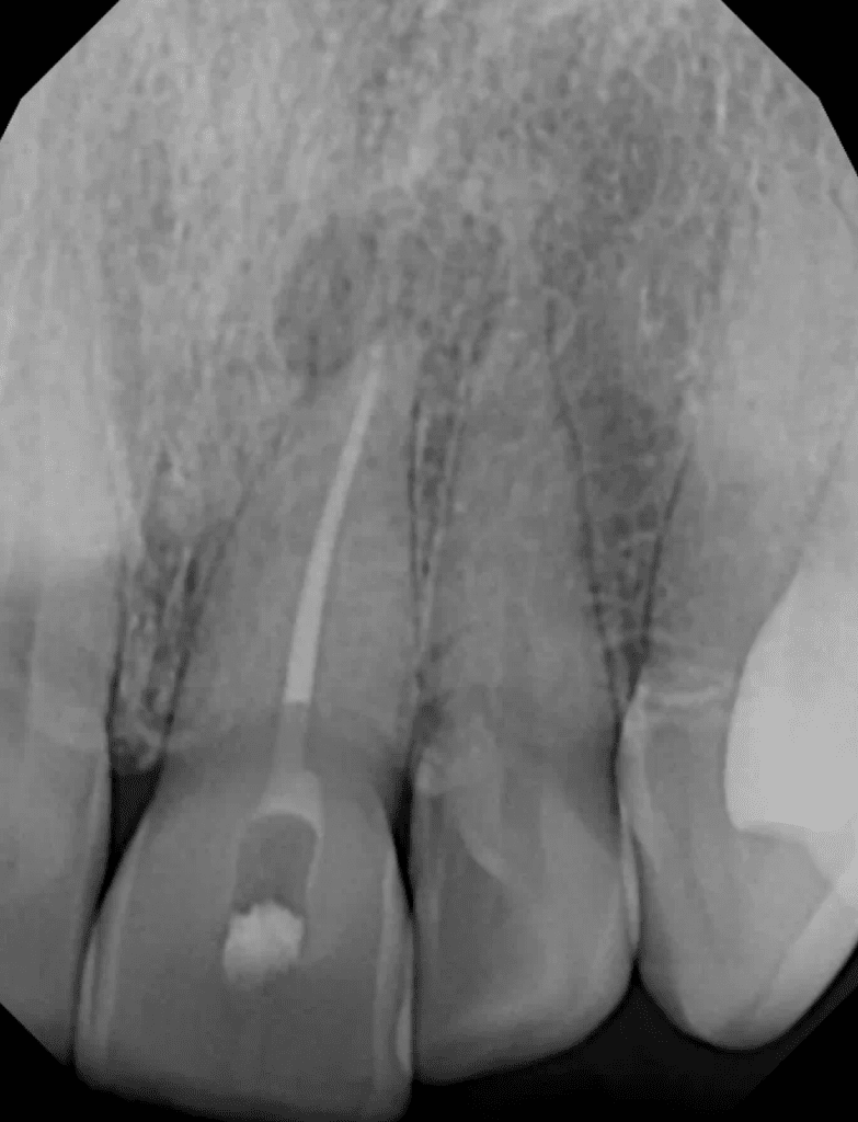 Calcified root canal by Cincinnati endodontist Dr. Matthew Sullivan of Mason Endodontics and Microsurgery.